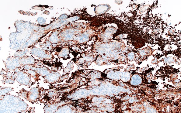 21D2 Meningioma, brain invasion (Case 21) GFAP 10X