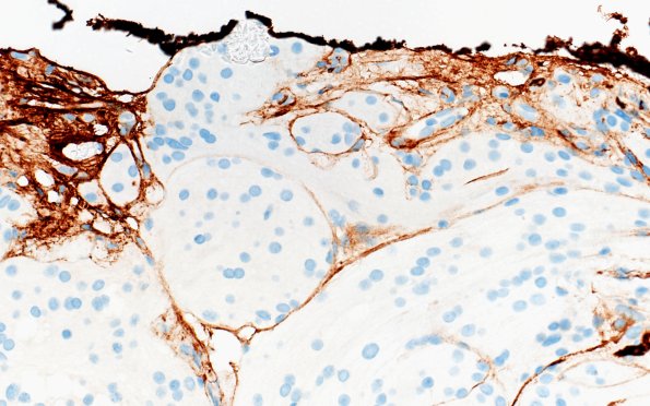 23A7 Meningioma, brain invasion (Case 23) GFAP 40X
