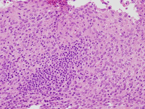 3A1 Meningioma & brain invasion (Case 3) H&E 3.jpg