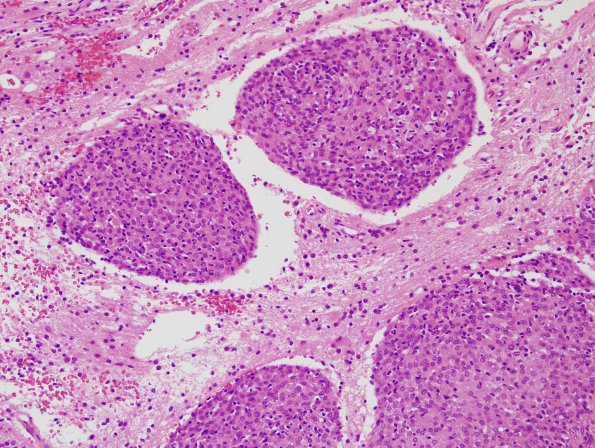 3A2 Meningioma & brain invasion (Case 3) H&E 6.jpg