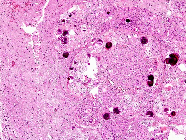 4A1 Meningioma & brain invasion (Case 4) H&E 5.jpg