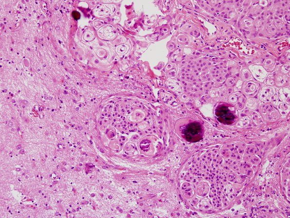 4A2 Meningioma & brain invasion (Case 4) H&E 1.jpg