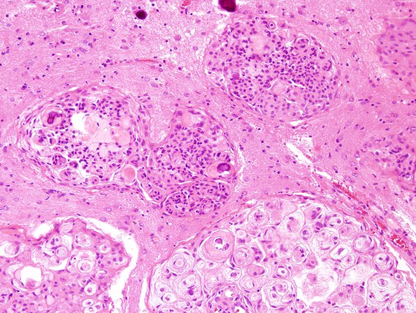 4A3 Meningioma & brain invasion (Case 4) H&E 2.jpg