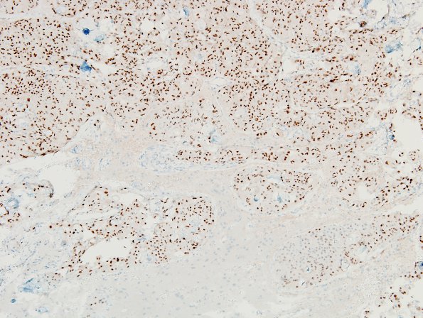 4B Meningioma & brain invasion (Case 4) PR 2.jpg