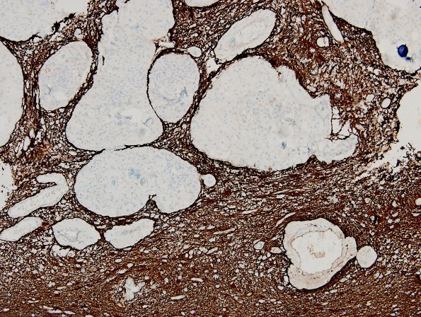 4C2 Meningioma & brain invasion (Case 4) GFAP 2.jpg