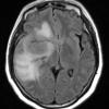 5A1 Meningioma, atypical, brain invasion (Case 5) FLAIR 2 - Copy