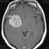 5A2 Meningioma, atypical, brain invasion (Case 5) T1 W 1 - Copy