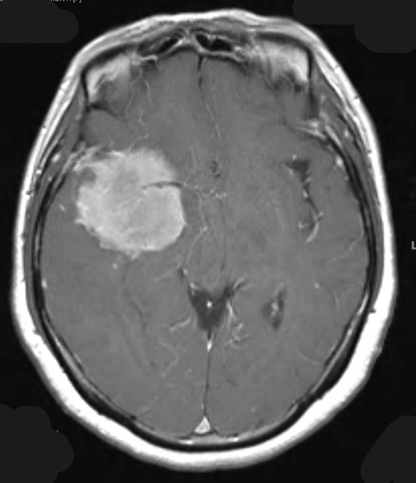 5A2 Meningioma, atypical, brain invasion (Case 5) T1 W 1 - Copy