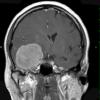 5A3 Meningioma, atypical, brain invasion (Case 5) T1 W 3 - Copy