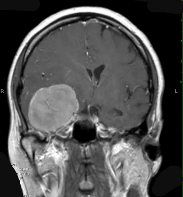 5A3 Meningioma, atypical, brain invasion (Case 5) T1 W 3 - Copy