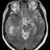 5A4 Meningioma, atypical, brain invasion (Case 5) T2 1 - Copy