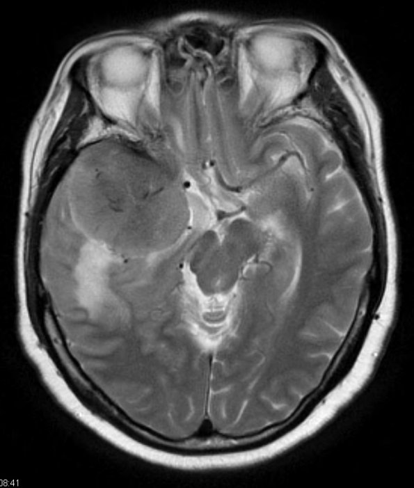 5A4 Meningioma, atypical, brain invasion (Case 5) T2 1 - Copy