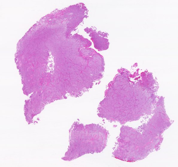 5B1 Meningioma, atypical, brain invasion (Case 5) H&E WM