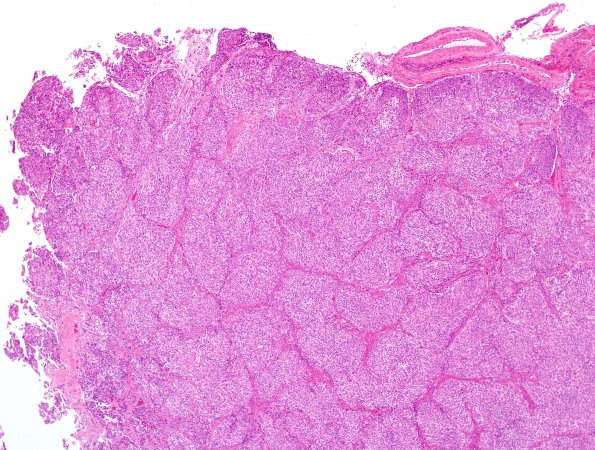 5B2 Meningioma, atypical, brain invasion (Case 5) H&E 7