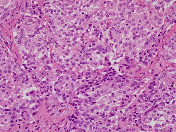 5B3 Meningioma, atypical, brain invasion (Case 5) H&E 1