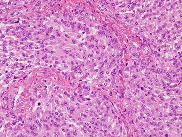 5B4 Meningioma, atypical, brain invasion (Case 5) H&E 4