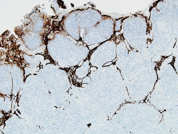 5C1 Meningioma, atypical, brain invasion (Case 5) GFAP 5