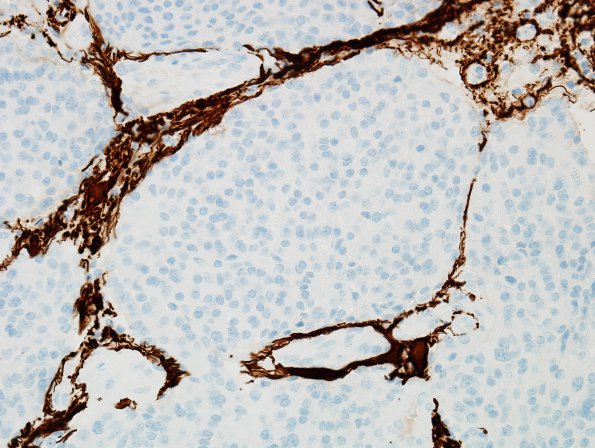 5C2 Meningioma, atypical, brain invasion (Case 5) GFAP 4