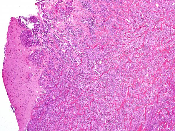 6A2 Meningioma, brain invasion (Case 6) H&E 4.jpg