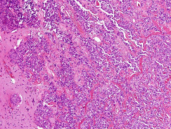 6A3 Meningioma, brain invasion (Case 6) H&E 3.jpg