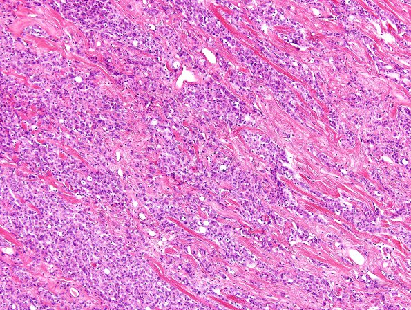 6A4 Meningioma, brain invasion (Case 6) H&E 16.jpg