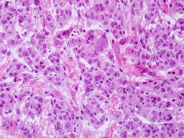 6A5 Meningioma, brain invasion (Case 6) H&E 10.jpg