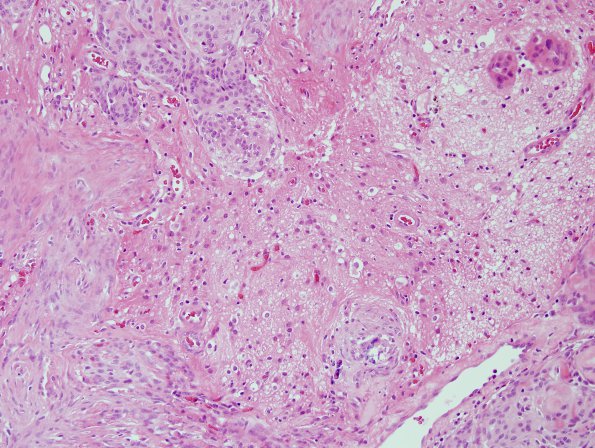 7A2 Meningioma, atypical w brain invasion (Case 7) H&E 2