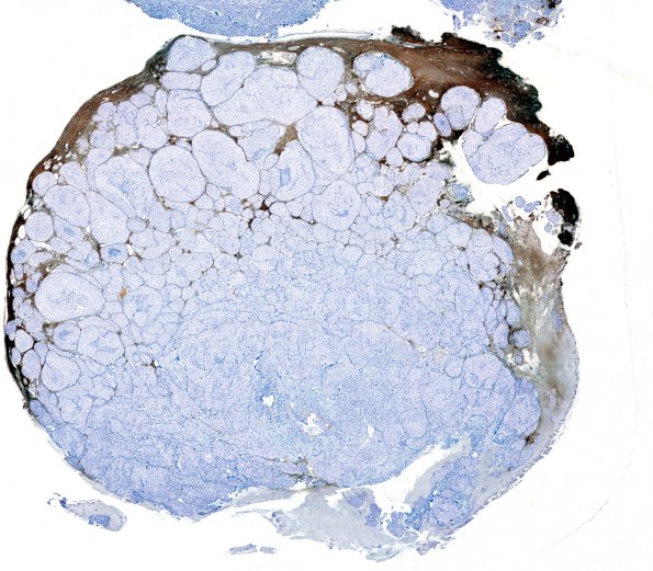 8A1 Meningioma, atypical, brain invasion GFAP b