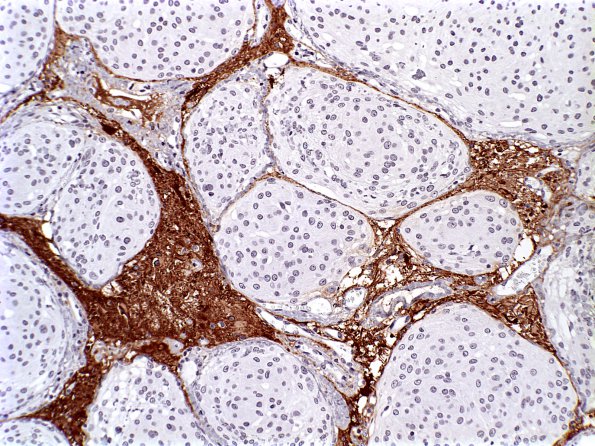 8A2 Meningioma, atypical, brain invasion GFAP a