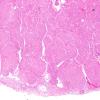 9A1 Meningioma, brain invasion (Case 9) H&E 4X