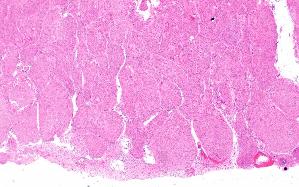 9A1 Meningioma, brain invasion (Case 9) H&E 4X