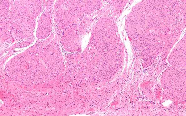 9A2 Meningioma, brain invasion (Case 9) H&E 10X