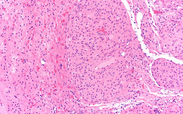 9A3 Meningioma, brain invasion (Case 9) H&E 20X