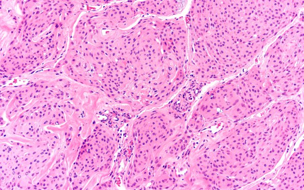 9A4 Meningioma, brain invasion (Case 9) H&E 20X