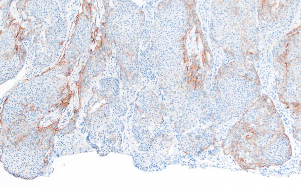 9B2 Meningioma, brain invasion (Case 9) EMA 10X