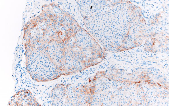 9B3 Meningioma, brain invasion (Case 9) EMA 20X