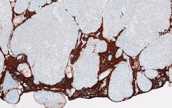 9D2 Meningioma, brain invasion (Case 9) GFAP 10X