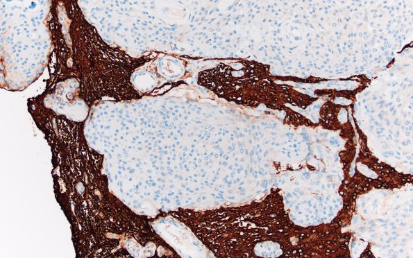 9D3 Meningioma, brain invasion (Case 9) GFAP 20X