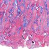 9E1 Meningioma, brain invasion (Case 9) TRI 4X