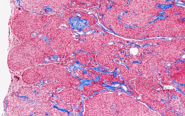 9E2 Meningioma, brain invasion (Case 9) B2 TRI 10X