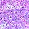 10A1 Meningioma, Chordoid (Case 10) Alcian Blue 1