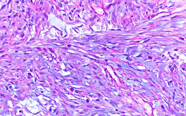 10A1 Meningioma, Chordoid (Case 10) Alcian Blue 1