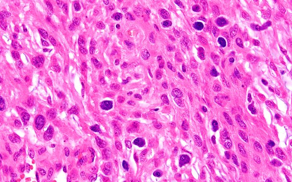 10A2 Meningioma, Chordoid (Case 10) H&E 3