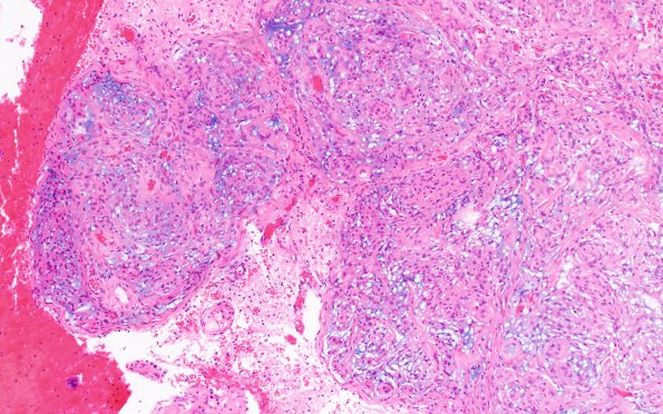 11A1 Meningioma, chordoid & invasion (Case 11) H&E 4X