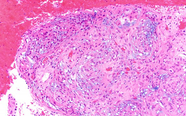 11A2 Meningioma, chordoid & invasion (Case 11) H&E 20X