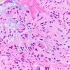 11A3 Meningioma, chordoid & invasion (Case 11) H&E 40X