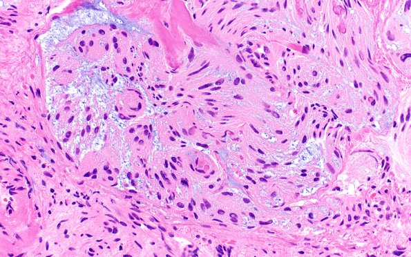 11A3 Meningioma, chordoid & invasion (Case 11) H&E 40X