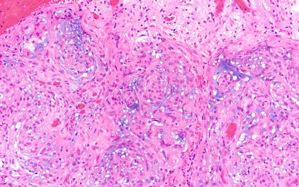 11A4 Meningioma, chordoid (Case 11) H&E 20X