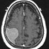 12A1 Meningioma, chordoid (Case 12) T1 W 1 - Copy