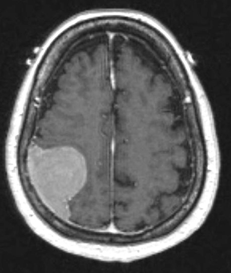 12A1 Meningioma, chordoid (Case 12) T1 W 1 - Copy